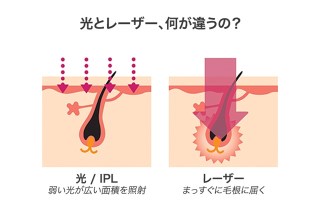 光とレーザー脱毛の違い