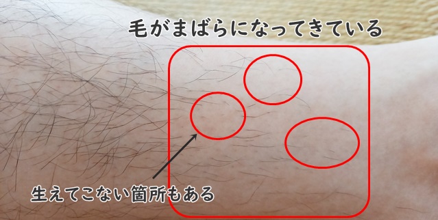 トリア脱毛器効果